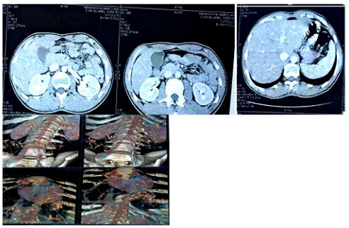 Figure 6: Thoracoabdominal CT angiogram without notable abnormalities.